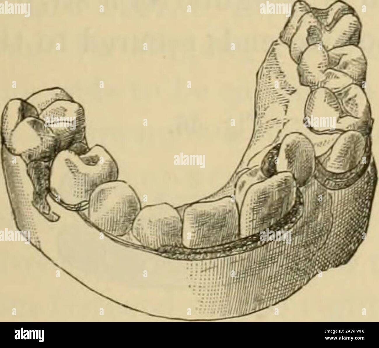 https://c8.alamy.com/comp/2AWFWF8/manual-of-dental-surgery-and-pathology-the-surgeons-knot-the-clove-hitch-suppose-it-be-desired-to-draw-a-single-tooth-out-to-a-positionin-the-arcii-corresponding-to-its-fellows-as-the-left-lateral-infig-43-take-a-piece-of-highly-elastic-rubber-conveniently-a-fis-43-fiff-44-o-o-o-rings-cut-from-rubber-tubing-drawing-a-tooth-forward-into-the-archby-an-elastic-ligature-after-a-plastercast-ring-cut-from-a-french-rubber-tubing-such-as-is-used-for-sepa-rating-teeth-fig-44-say-from-ith-to-ith-inch-in-diameter-tieto-this-by-a-square-knot-a-piece-of-strong-sewing-machine-shoe-76-2AWFWF8.jpg