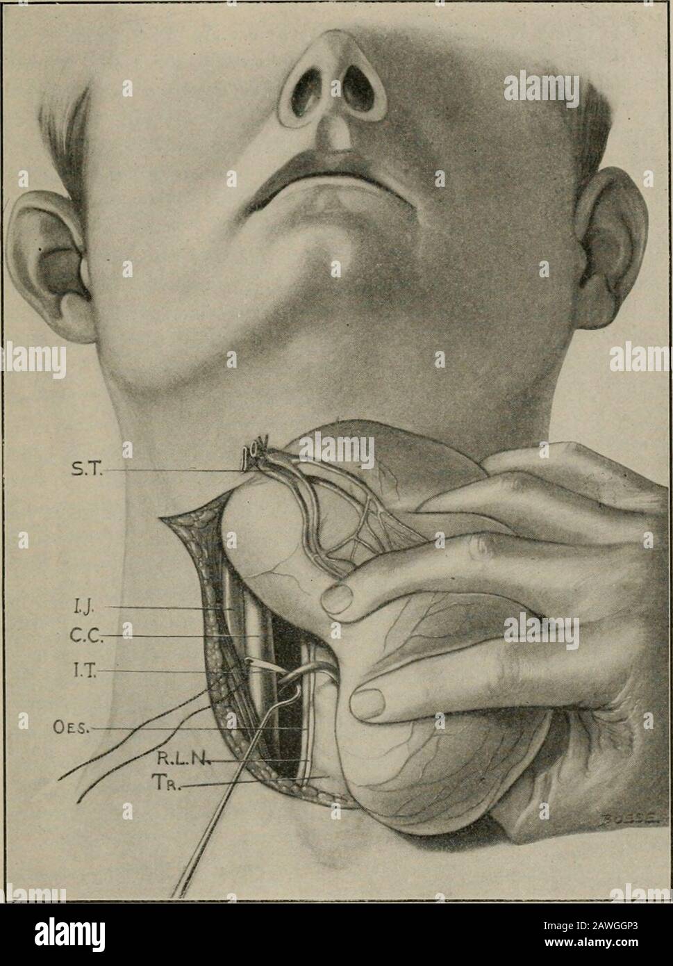 Operative surgery, for students and practitioners . scles have been divided  their endsshould be reunited by suture? A cigarette drain which is allowed  toremain for twentj-four hours is introduced. The edges of
