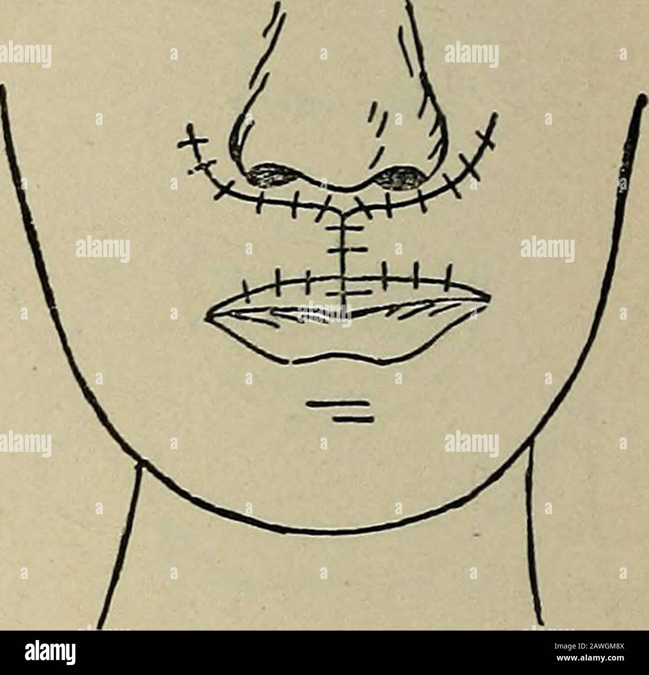 Operative Surgery For Students And Practitioners Wo Fig 131 Dieffenbach Wellenschnitt Forrestoration Of The Upper Lip An In Cision Wd Is Carried Around Each Sideof The Nose Extending Through Thecheek Fig 132 The Flaps