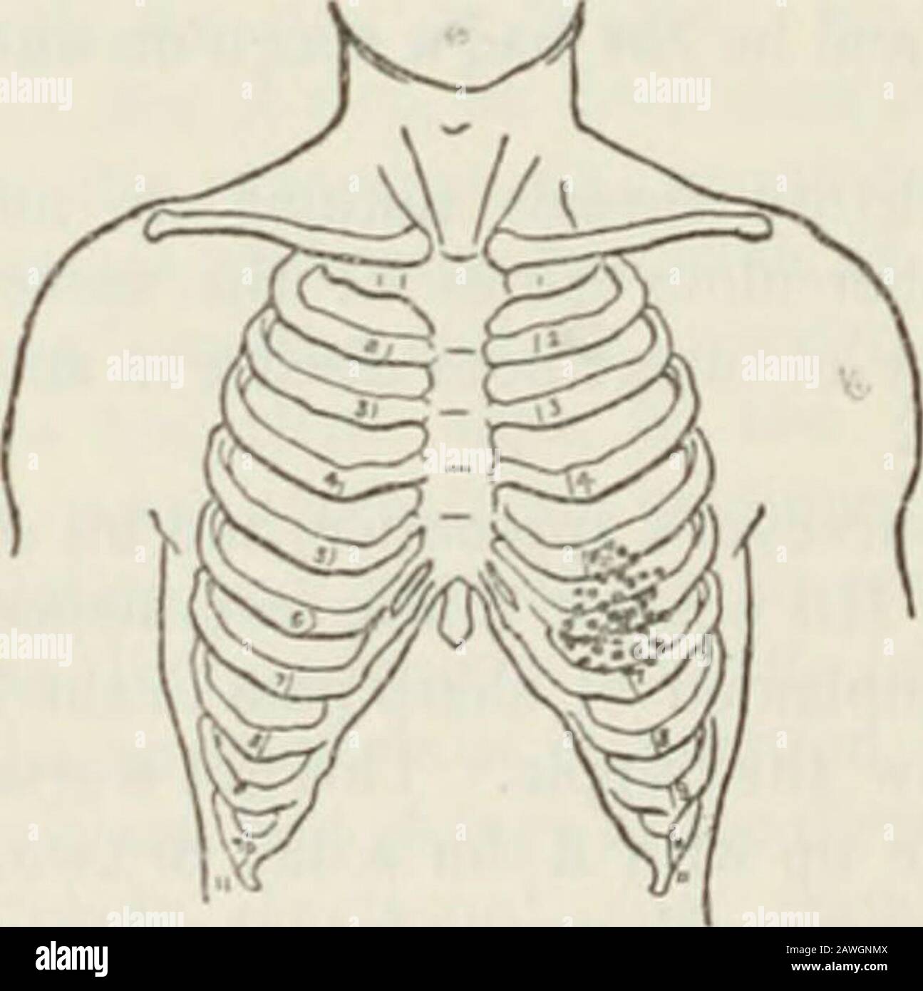 The Practitioner . Respiration 28 per minute, not laboured.He has a frequent cough, which is somewhat paroxysmal and isnot suppressed to any extent. He brings up small quantitiesof slightly frothy mucopurulent sputum. Examination of chest shows it to be rather flat but fairlywell formed. Expansion is equal on the two sides. Vocalfremitus is well marked everywhere, except over the left baseposteriorly, where it is slightly lessened. Percussion shows slight impairment of note over the leftbase posteriorly, and also a rather high-pitched note over theleft apex posteriorly. Palpation reveals the p Stock Photo
