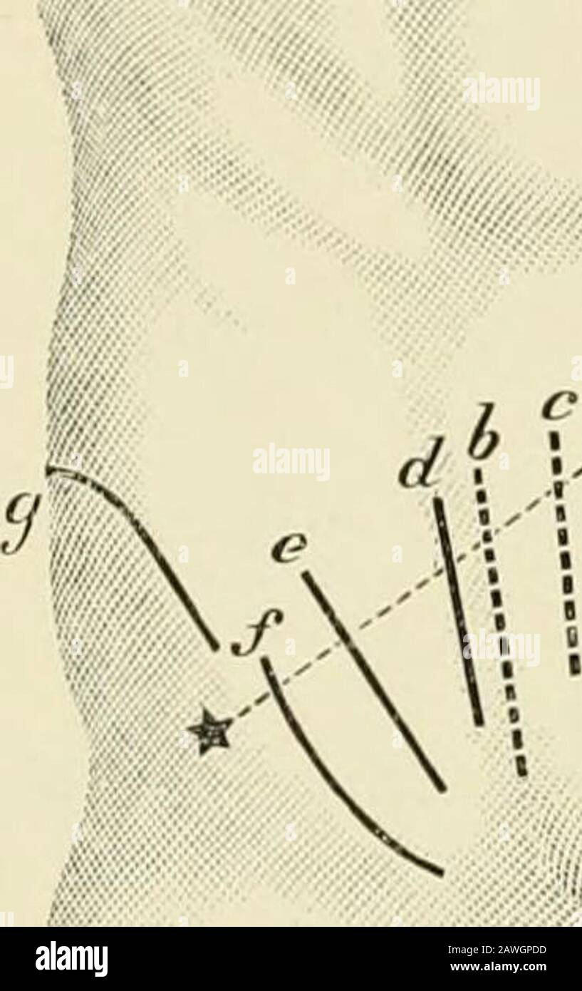 Operative Surgery Fig I 22 Iiistrmiients Employed In Openition For Appendicitis A Scalpels L Gt Uistouries C Forcipressure D Curved And Straight Scissors E Tliumbforceps F Ncedledioldcr H Retractors I Sponge Holder Wicking Operative Surgery Fig I 22 Iiistrmiients Employed In Openition For Appendicitis A Scalpels L Gt Uistouries C Forcipressure D Curved And Straight Scissors E Tliumbforceps F Ncedledioldcr H Retractors I Sponge Holder Wicking