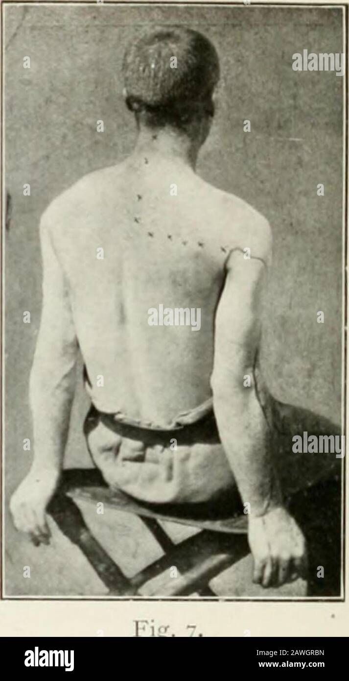 The Practitioner . lie. Showing area of skin supplied by cervical sympathetic, bounded by crosses Blackline on arm indicates boundary of analgesia. Stock Photo