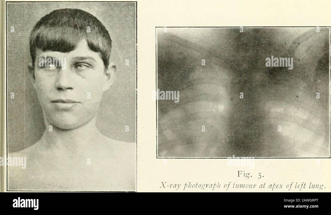 The Practitioner . Fig. 2. Paralysis of R. cervicalsynipati die from opcrationtnOiiiid. Fig. 3. Paralysis of R. cervical5; mpathetic from rupture of brachial plexus.. Fig- 5-X-ray plioto^raph of lumour at apex of left luni^ i&lt;T. 4. Paralysis of L. cervical sympatheticfrom tumour at apex of lung. Pl-ATK XVII. Stock Photo