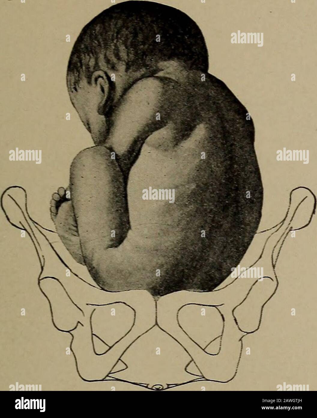 A nurse's handbook of obstetrics, for use in training-schools . Fig. 48 ...