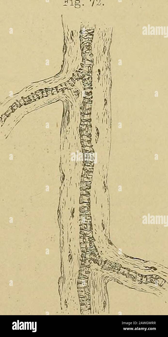 Kidney diseases, urinary deposits, and calculous disorders : their nature and treatment . ery from the kidney of a child, 3 years old, showimscular fibre cells and longitudinal nuclei of. muscular andelastic fibres within. X 215. .Artery I iota the peritoneum ot a frhad been kept for some time -nthshowing wasting of muscular fibregreat diminution in calibre. In itwasted and contracted state the Fig. 74. Stock Photo