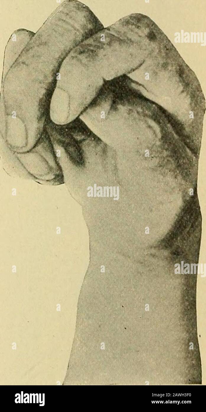 A system of practical medicine . Arthritis deformans, showing permanent