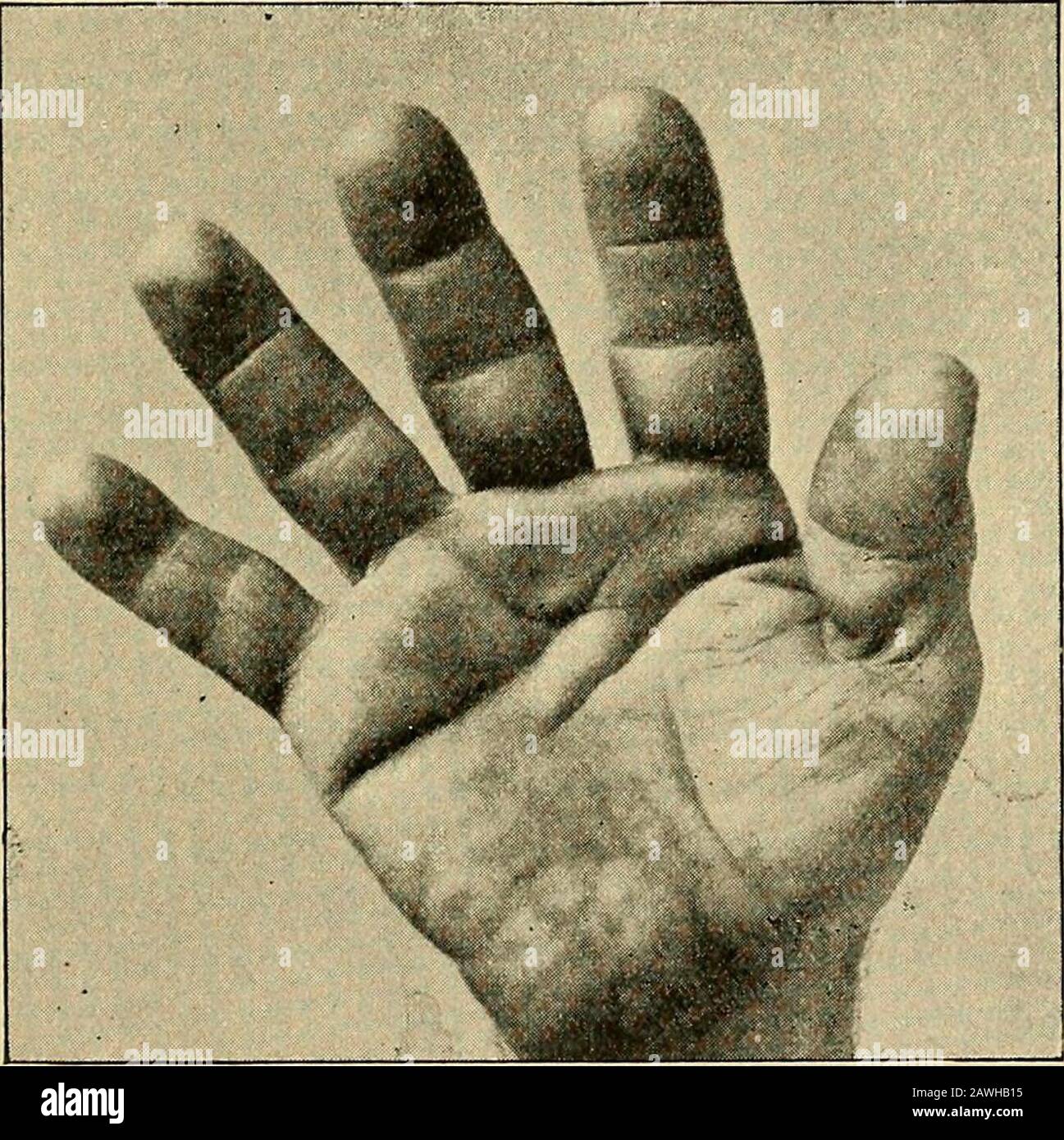 A system of practical medicine . ptoms of the disease.The skin is hard