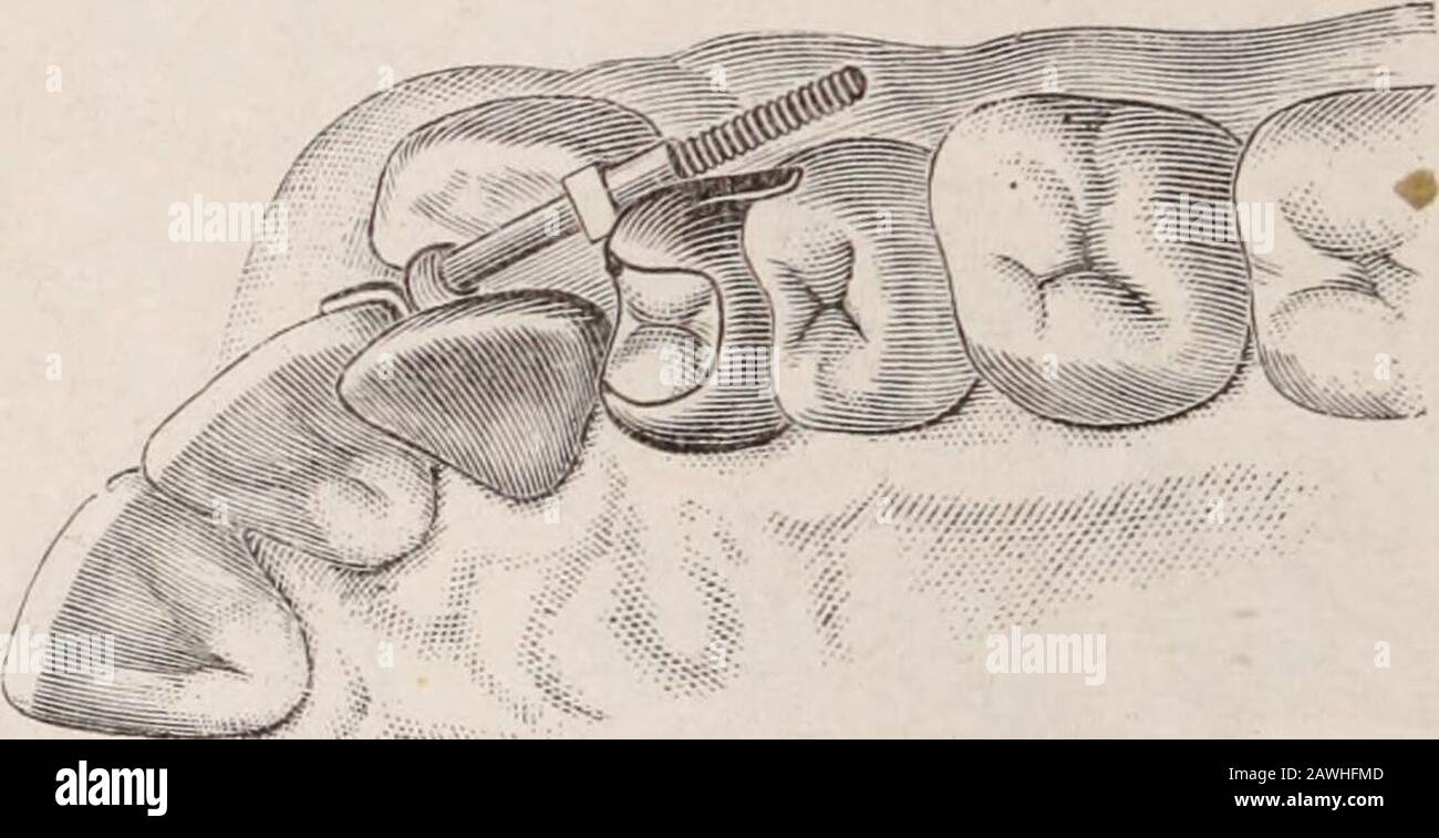 Dental cosmos . -tvvo-carat gold, ofabout No. 30 thickness, and fitted snugly to the plaster, and in thecase of the bicuspid the gold was carried up and just a little over thecusps, as shown in Fig. 3. The cap for the lateral incisor was provided with a socket on thelabial surface, into which the bar was fitted, allowing of some move-ment while the teeth were being pushed toward the median line.This cap was also provided with a small arm or lug, which bore againstthe adjoining tooth in such a manner as to prevent the capped toothfrom being pushed out of line while the space between them was be Stock Photo