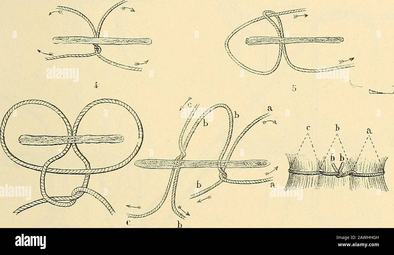 Traité de gynécologie clinique et opératoire . Fig. 54. — 1. Nœud du chirurgien mal fait. — 2. Nœud du chirurgien bien fait. -*- 5. Transfixiondu pédicule avec une aiguille montée armée dune anse de fil. — 4. Croisement des deuxchefs du fil après la transfixion du pédicule. — 5. Nœud de Cantock pour la ligature despetits pédicules. — 6. Nœud de Lawson-Tait (Staffordshire knot) pour la ligature des petits pédicules (lanse doit être renversée par-dessus la tumeur). — 7. Ligature en chaîne sur un pé-dicule large; croisement des fils. — 8. Ligature en chaîne sur un pédicule large; les fils sontnou Stock Photo