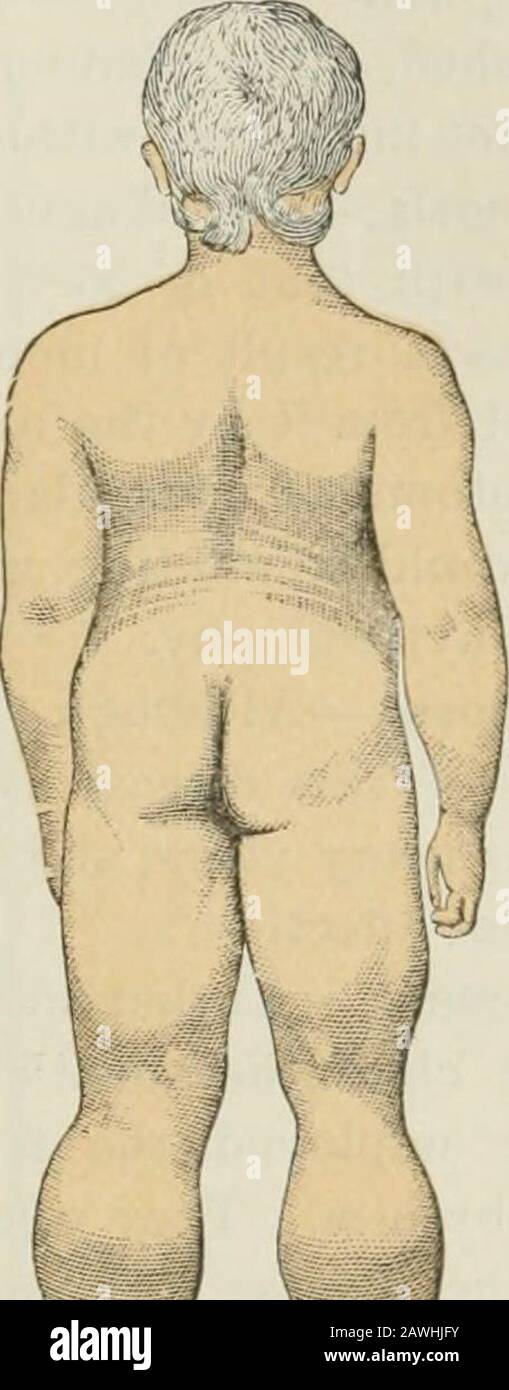 Lectures on nervous diseases from the standpoint of cerebral and spinal localization, and the later methods employed in the diagnosis and treatment of these affections . the. Fig. 112.—Side View of Attitude of Pseudo-hypertrophic Paralysis. (Duchenne.) Fig. 113.—Rear View of Attitude of Pseudo-hypertrophic Paralysis. (Duchenne.) arm/ This movement of climbing up the thighs, as it has beentermed, is an indication of weakness in the muscles which straightenthe knee, and also those which extend the trunk upon the thigh,—theextensors of the hip-joint. (See Figs. 52 and 53.) The (jait of these iiat Stock Photo