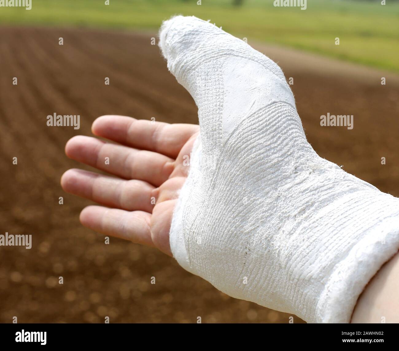 Man's hand in plaster and fully invoiced especially the thumb Stock ...