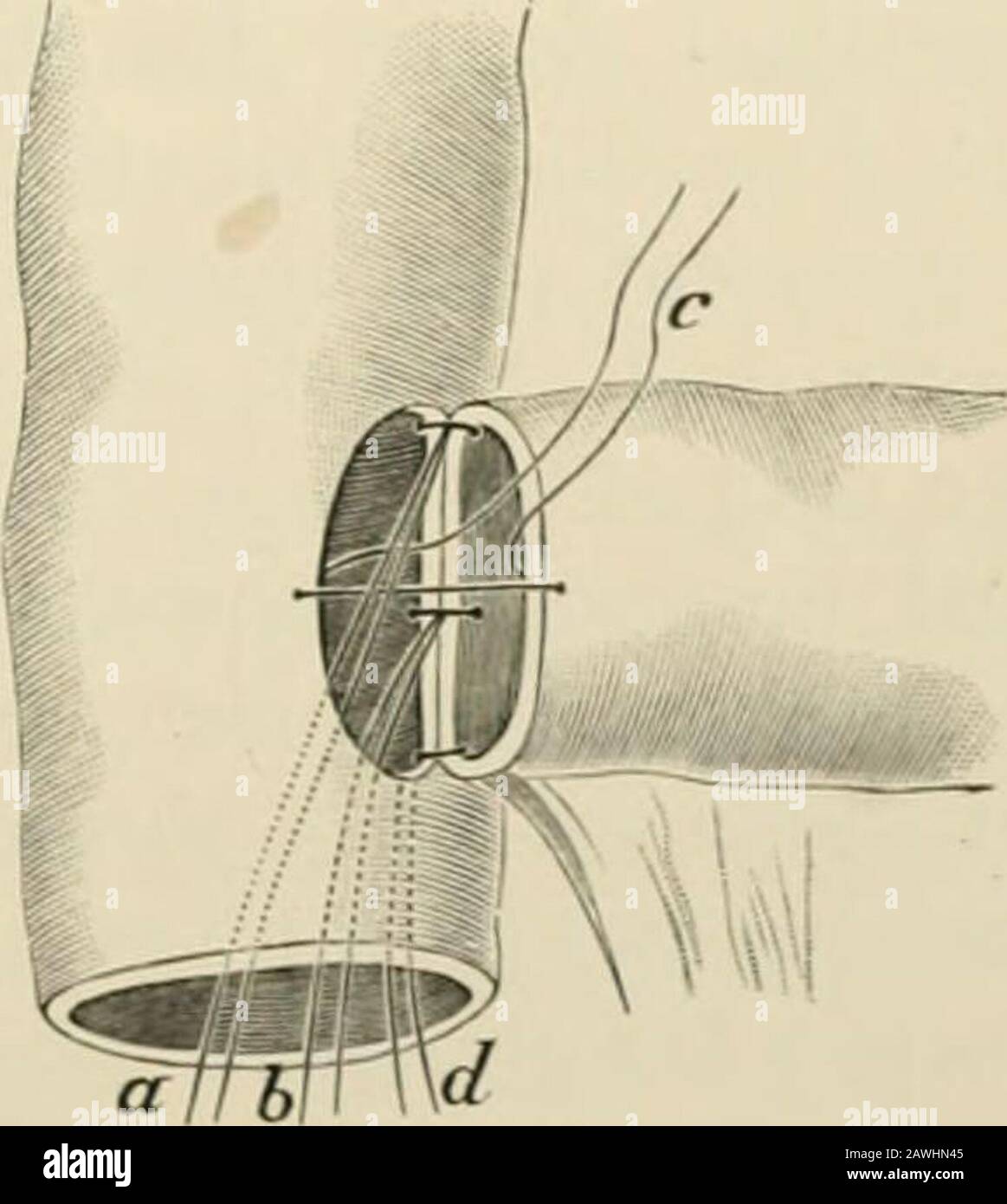 Operative Surgery Fi I So7 V 85s Fig 857 Lateral Implantation Maunscirs Method A B C D Sutures In Position Fig 858 Lateral Implantation Maunsells Method A B D Sutures Carried Throughopen End Of Colon C Suture Remaining Behind Its