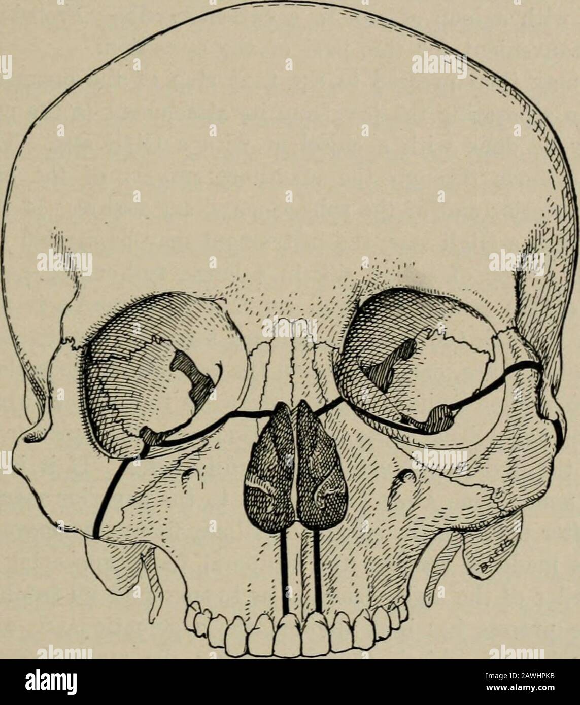 Operative surgery, for students and practitioners . Fig. 75.—Resection of Upper Jaw. L, Langenbeck incision; V, Velpeauincision; W, Weber incision. the lower border of the lobe of the ear, and is then carried upwardto a point over the prominence of the cheek-bone. This incisiondoes not divide the lip, but it will be necessary later to separatethe lip from its attachment to the jaw-bone. It divides some branchesof the facial nerve, which is a disadvantage. The front surface ofthe bone is exposed by reflecting the flap upward, subperiosteally, if OPERATIONS UPON THE FACE. 145 the conditions perm Stock Photo