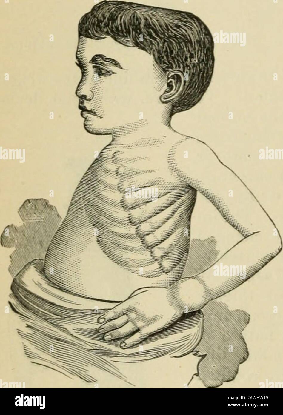 An American text-book of the diseases of childrenIncluding special chapters on essential surgical subjects; orthopaedics, diseases of the eye, ear, nose, and throat; diseases of the skin; and on the diet, hygiene, and general management of children . e rendering it more easilyacted on by the muscles. The changein the upper jaw-bone he attributeslargely to lateral pressure of the zygo-matic arches. Changes in the Ribs.—The ribs areeasily affected in rachitis. The swell-ing of their anterior ends, where theyunite with the costal cartilages, pro-ducing the rachitic rosary, has beenalready alluded Stock Photo