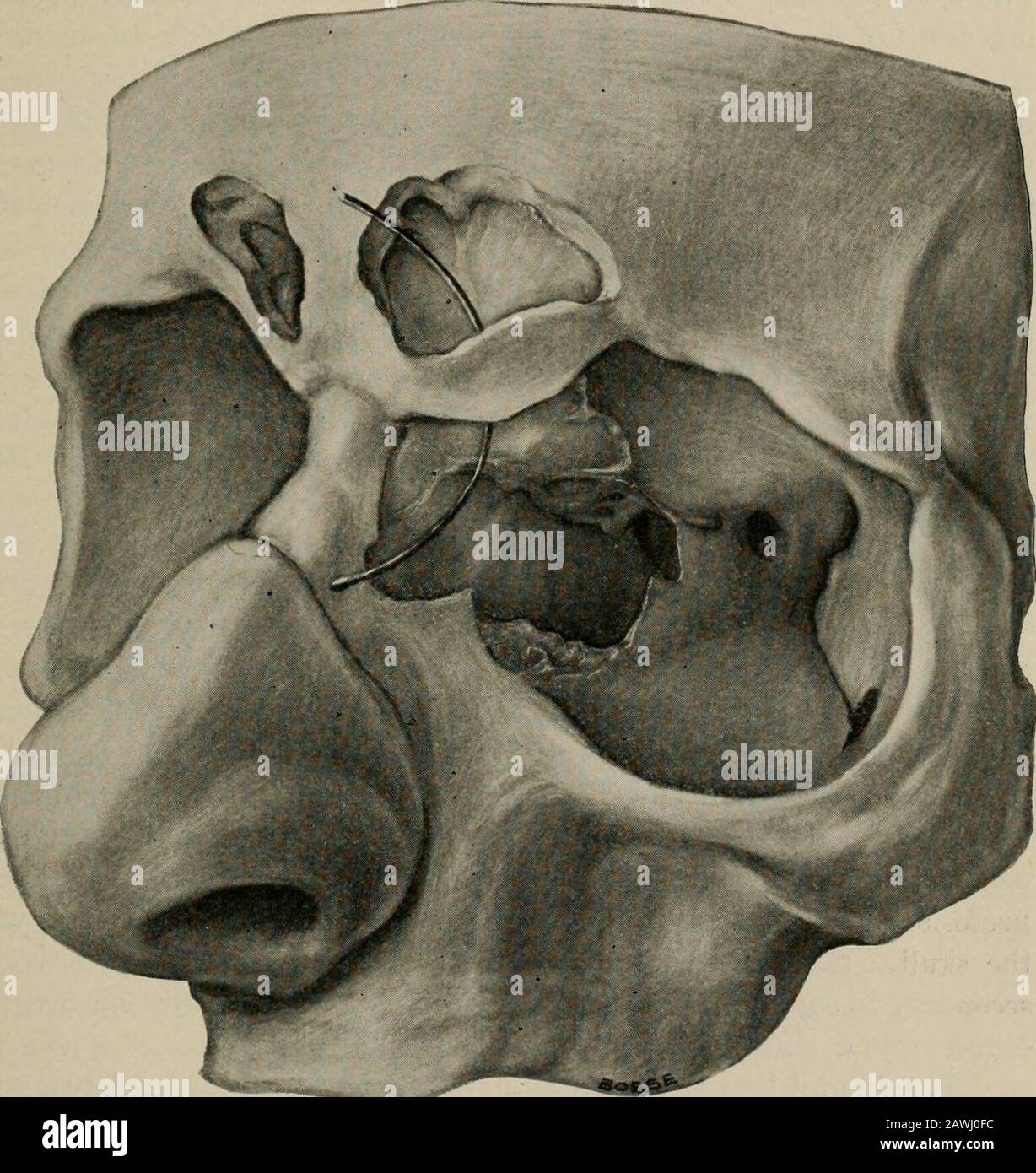 Operative surgery, for students and practitioners . e bone, upward, awayfrom the supra-orbital incision, thus denuding the surface of bonecorresponding to the anterior wall of the frontal sinus, and doAvn-ward, away from the lower periosteal incision, denuding the bonecorresponding to the inner part of the roof of the orbit. The peri-osteum covering the bridge of bone which it is proposed to leave tosupport the soft parts is thus left undisturbed. The front wall ofthe sinus is penetrated with a chisel and mallet, and a considerableopening made with the rongeur bone-forceps. The mucous membrane Stock Photo