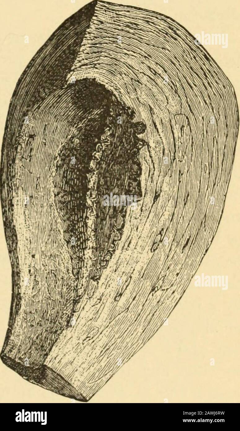 A system of obstetrics . erine mucous membrane in the early part of pregnancy, greatly hy- pertrophied and thickened, before it has undergone the physiological atro-phy that begins in the third month, is very different from the delicate membrane which lines the uterus at term. This thickened uterine decidua, suddenly cut off from the greater part of its blood-supply by contraction of the uterine wall, becomes a mass of dead animal flesh within the uterus, and soon begins to putrefy, or else portions of the decidua attract an increased blood-supply, retain their original development, or even in Stock Photo