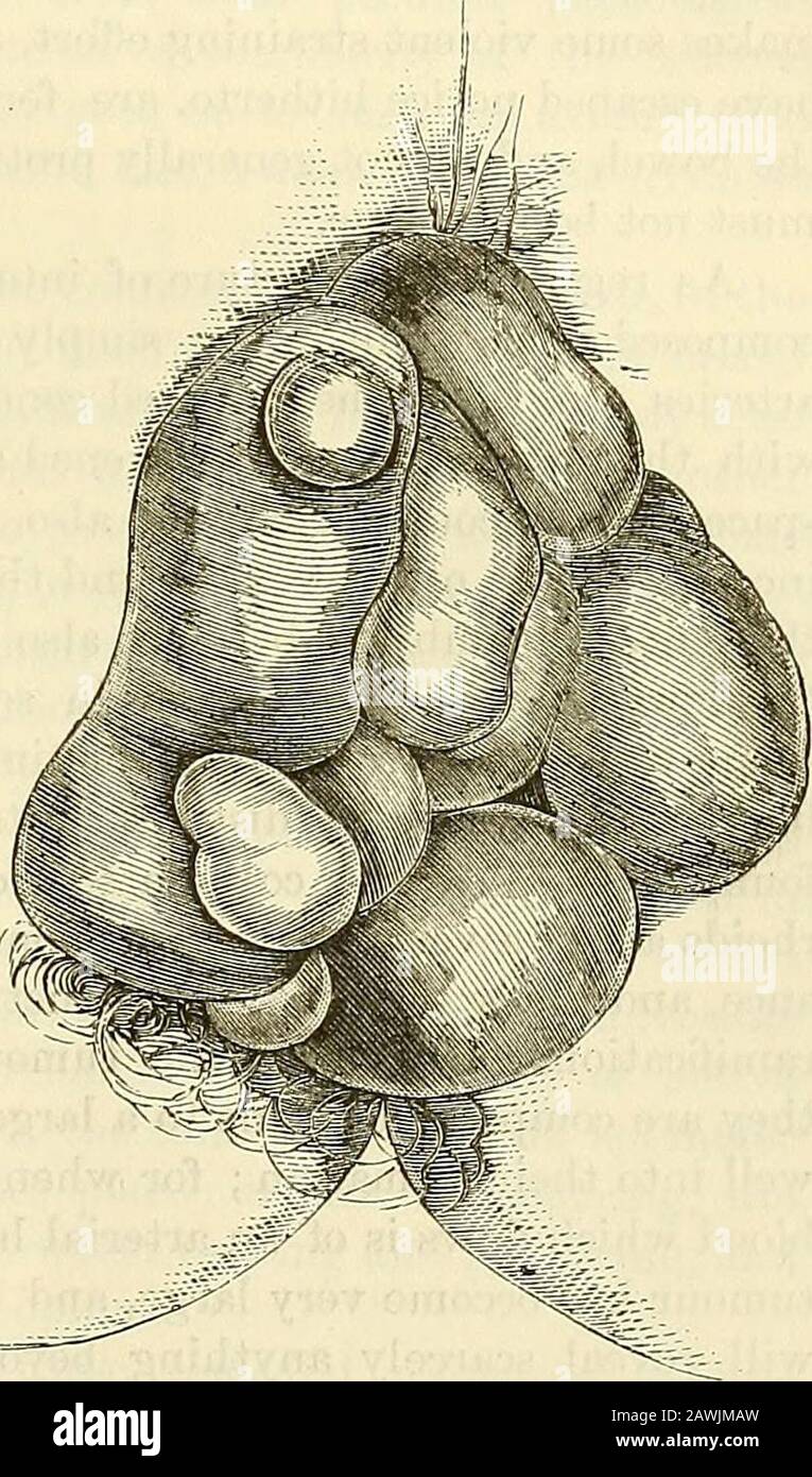 A system of surgery : theoretical and practical . ouston, of Dublin, likened to the diseased lining membrane of thepalpebrae in cases of chronic conjunctivitis. In the majority of instances, however, ofinternal haemorrhoids, one or more distinct tumours of a rounded or oblong form will beseen to fill up, as it were, the orifice of the anus. In some cases their character andsize can be ascertained by an ordinary inspection; but it is always best, in order toarrive at a proper diagnosis, to throw up an injection of warm water, and allow it tobe discharged before the examination is made. By this Stock Photo