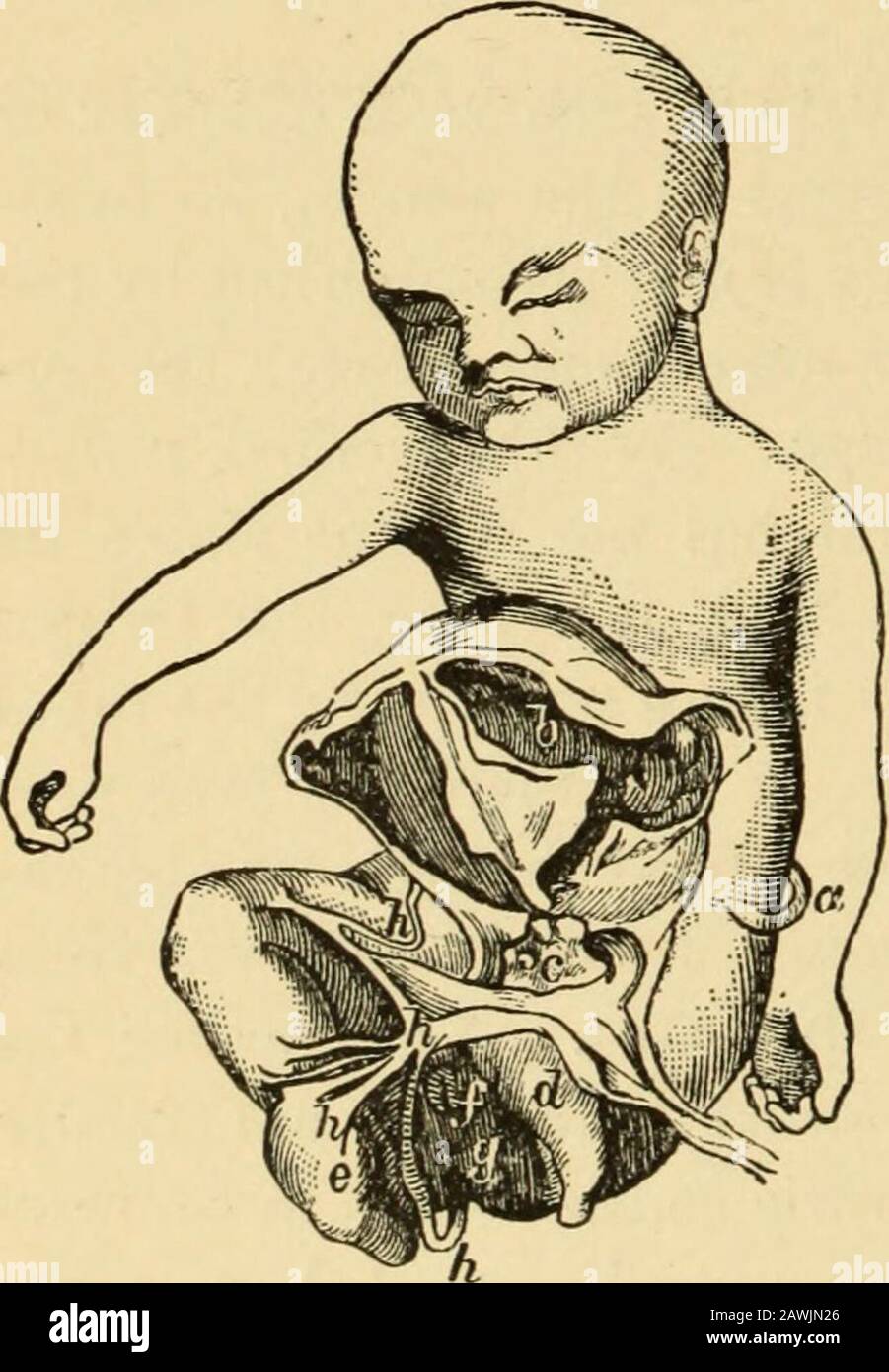 A system of obstetrics . loselyresembles that of the plastic materialthrown out in inflammations of theserous membranes generally. They arenot provided with blood-vessels. Theexudation of this plastic material fromthe amnion has as a result the forma-tion occasionally of extensive adhesionsbetween the foetus and the amnion, re-sulting often in grave deformities, aseventration or anencephalus, by pre-venting the proper arching over of thebody-cavities by the foetal skin. Theformation of adhesive bands, moreover, Amniotic Bands (G. Braun): a, bridge of Jg most frequently followed by illtra-skin; Stock Photo