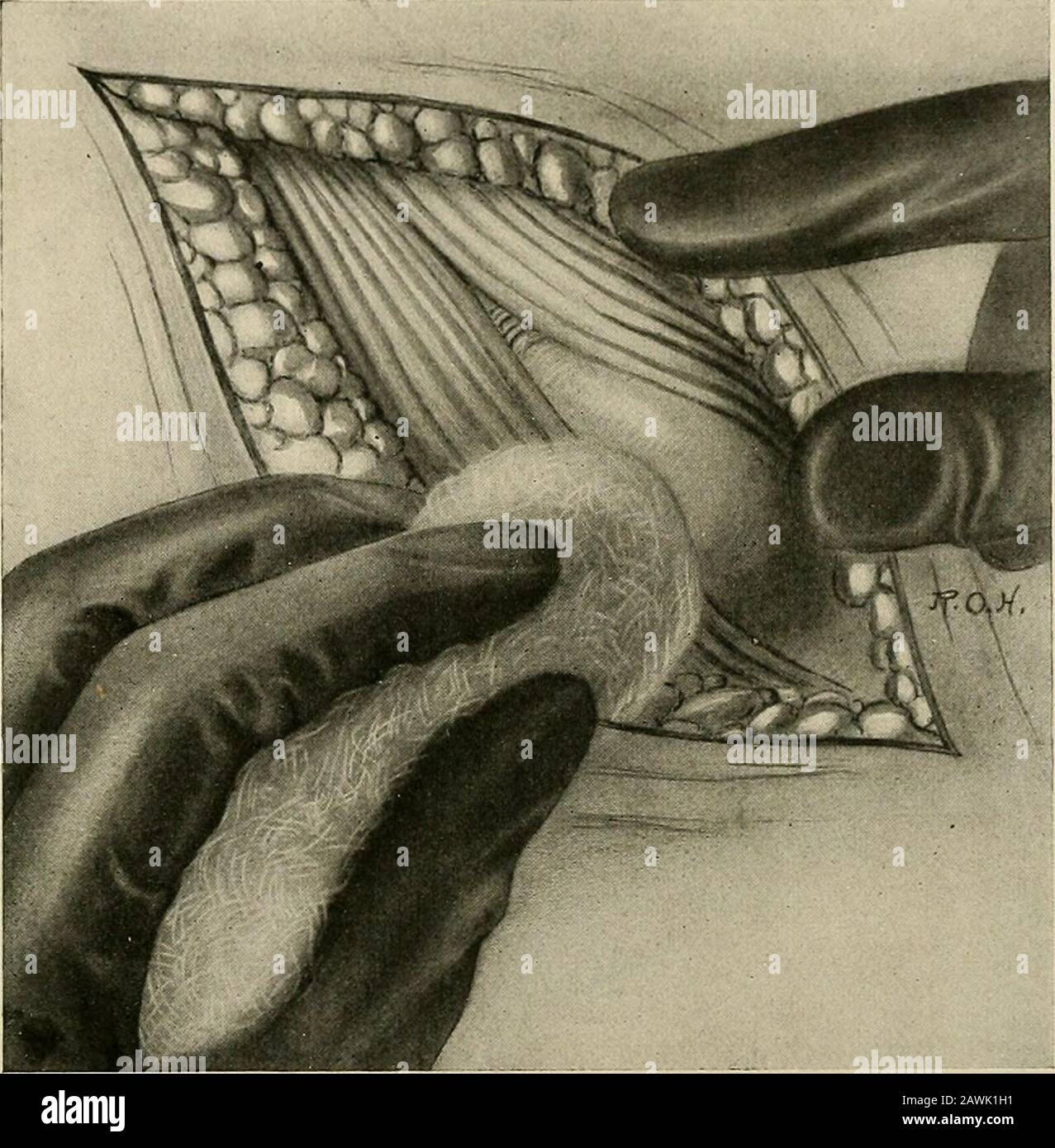 The practice of surgery . ackfrom the underlying conjoined tendon with further gauze dissection.You will see that the deep parts are now thoroughly exposed down tothe preperitoneal fat. The hernia bulges into the wound, its sac closely INGUINAL HERNIA 207 associated with the coverings of the spermatic cord. The suigeonmust next separate carefully the cord from the sac. One cannot alwaysdo this without tearing apart the structures of the cord, but this makesno difTerence so long as the vas, the arteries (especially the artery of thevas), and two or three good-sized veins are left. The sac is mo Stock Photo