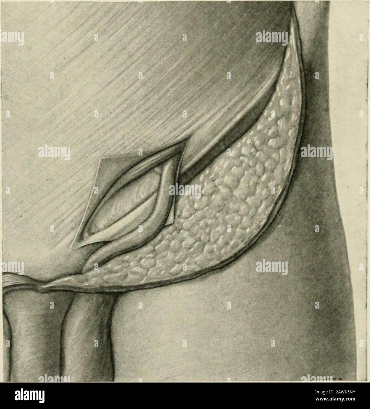 The practice of surgery . rries before it none of these structures except the peritoneum.The nerve-supply of these parts is interesting, and it is wise to sparenerve-branches in operating upon hernia. The terminal branches of 202 THE ABDOMEN the ilio-inguinal nerve emerge at the external abdominal ring, and thehypogastric branch of the iliohypogastric perforates the aponeurosisof the external obliciue above and to the outer side of the external ring. There are three arteries—two of them important: the spermaticartery, which supplies the testicle; the artery of the vas deferens,lying in the she Stock Photo