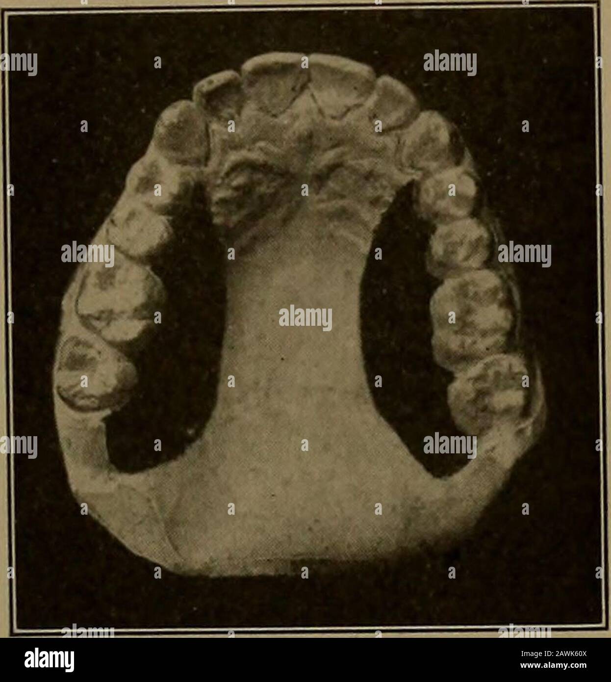 Stuttering and lisping . of of the mouth. It isdusted with chalk and ...