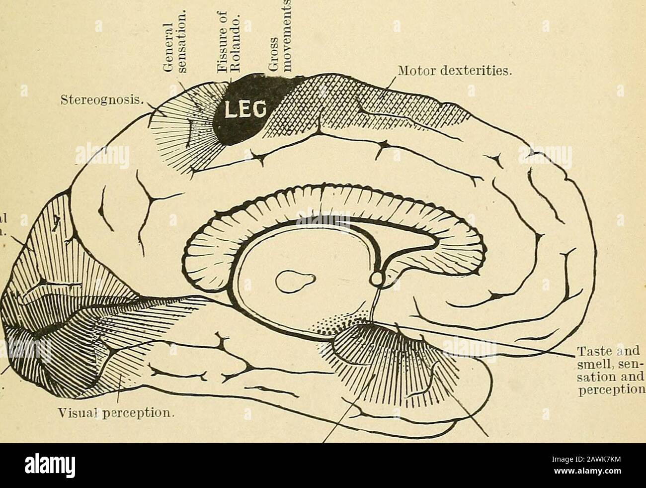 auditory cortex damage auditory cortex damage