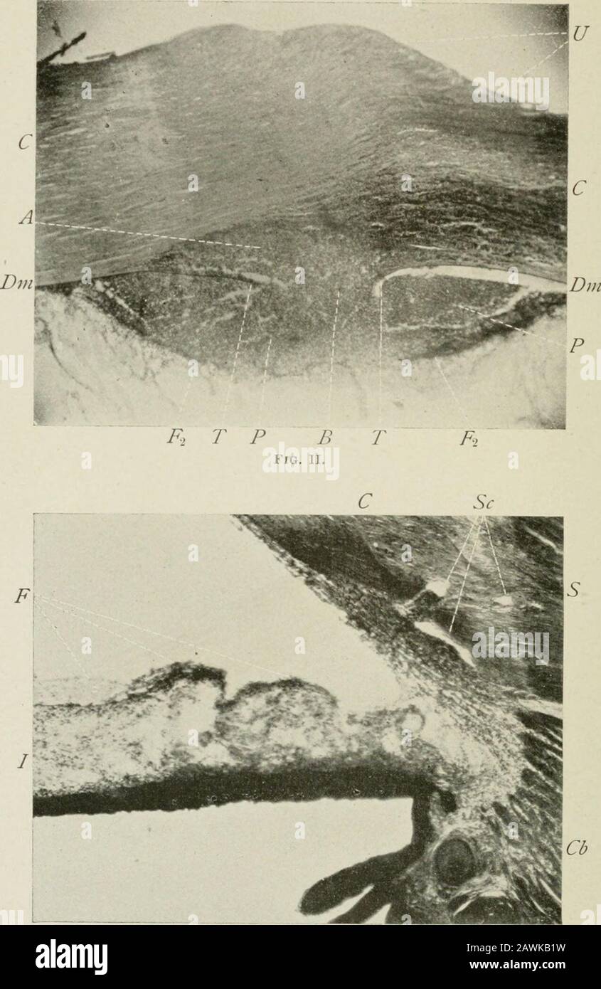 Transactions . AP U FIG. I.A, Abscess; F, J, Fi, Fv., fibrin; H, Injpopyon: P, pus: Sc, Schlemms canal; U, ulcer. ( The part of iliisplate shotting tlie fibrous net work, Fi to Fa, has been slightly retouchedon the plate.). Fig. III. A, abscess; B, break in DescemeVs membrane; C, cornea; Cb,ciliary body; Urn, Desremetsvembrane; F. l&gt;,fibiin; I. iris; P,}ms; S, sclera: So, Sclikmms canal; T, broken ends ofDcsceiiitVs ii,einbrune; U, ulcer. Green and Ewing : Hypopyon-Keratitis. 719 apart, and at Descemets membrane it passes into a smallabscess (Figs. I and II, A), measuring i mm. vertically, Stock Photo