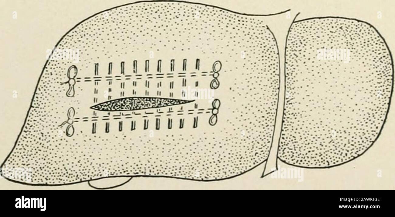 The practice of surgery . - single, and may grow to the size of a hens egg, beingsituated near the suspensory ligament usually or near the entranceof the portal vein. Lobulation results from cicatricial contraction fol-lowing the absorption of syphilitic nodules.. Fig. 84.—Knotts method of suturing the liver. Tlie transverse interrupted sutures introduced. The symptoms of syphilitic liver are indefinite and somewhat various.The first evidence is often a movable lobe suggesting floating kidney,or there may be ascites, due to pressure on the portal vein; jaundiceis .rare. These tumors cannot alw Stock Photo