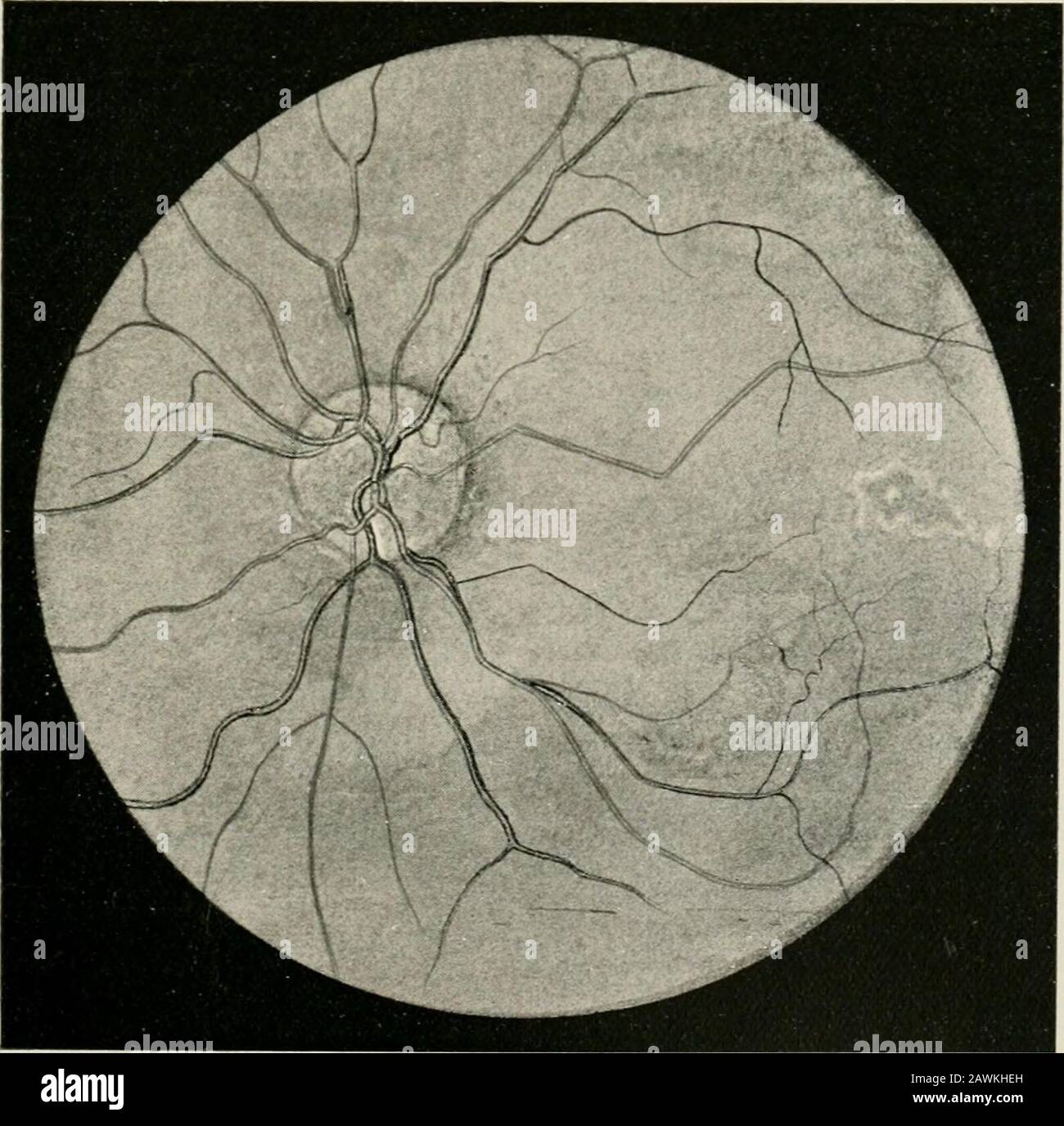 Transactions . Ophthalmoscopic appearance of right eye-ground.Fio. 2.. Ophthalmoscopic appearance of left eye-ground. Oliver: Double Chorio-Retinitis. 617 rhages of any character could be detected, and no signs of de-generation of any type, except that the nerve-head was a trifiehazy and gray, could be determined. The retina of the left eye apparently was not affected in anyway, except that here, too, the nerve-head was a trifie too grayfor age, and was somewhat hazy. The patient, who seemed strong and hearty, strenuously de-nied any syphilitic infection, and, after the most careful phys-ical Stock Photo
