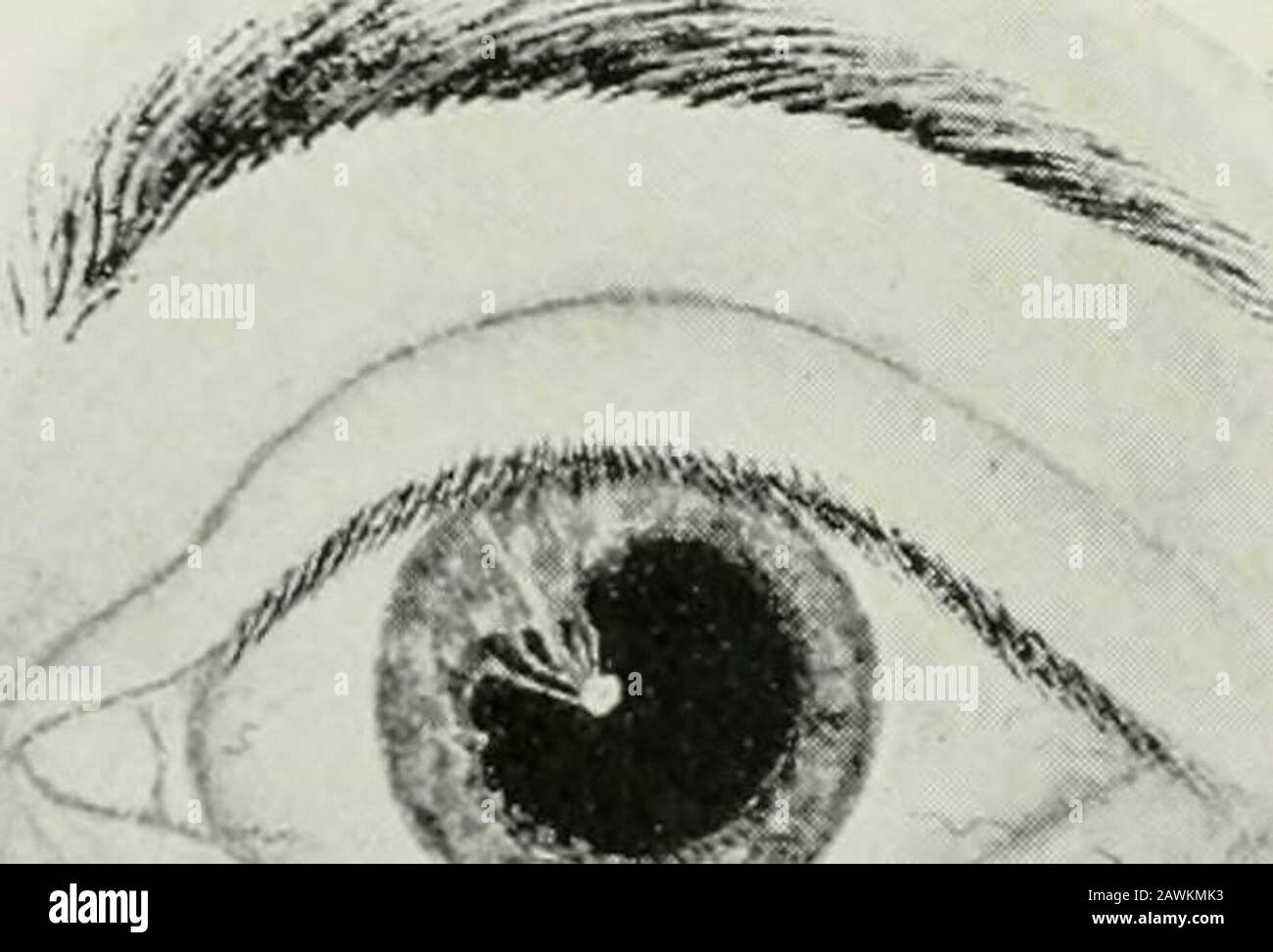 Ppm In Eye Partial Persistent Pupillary Membrane