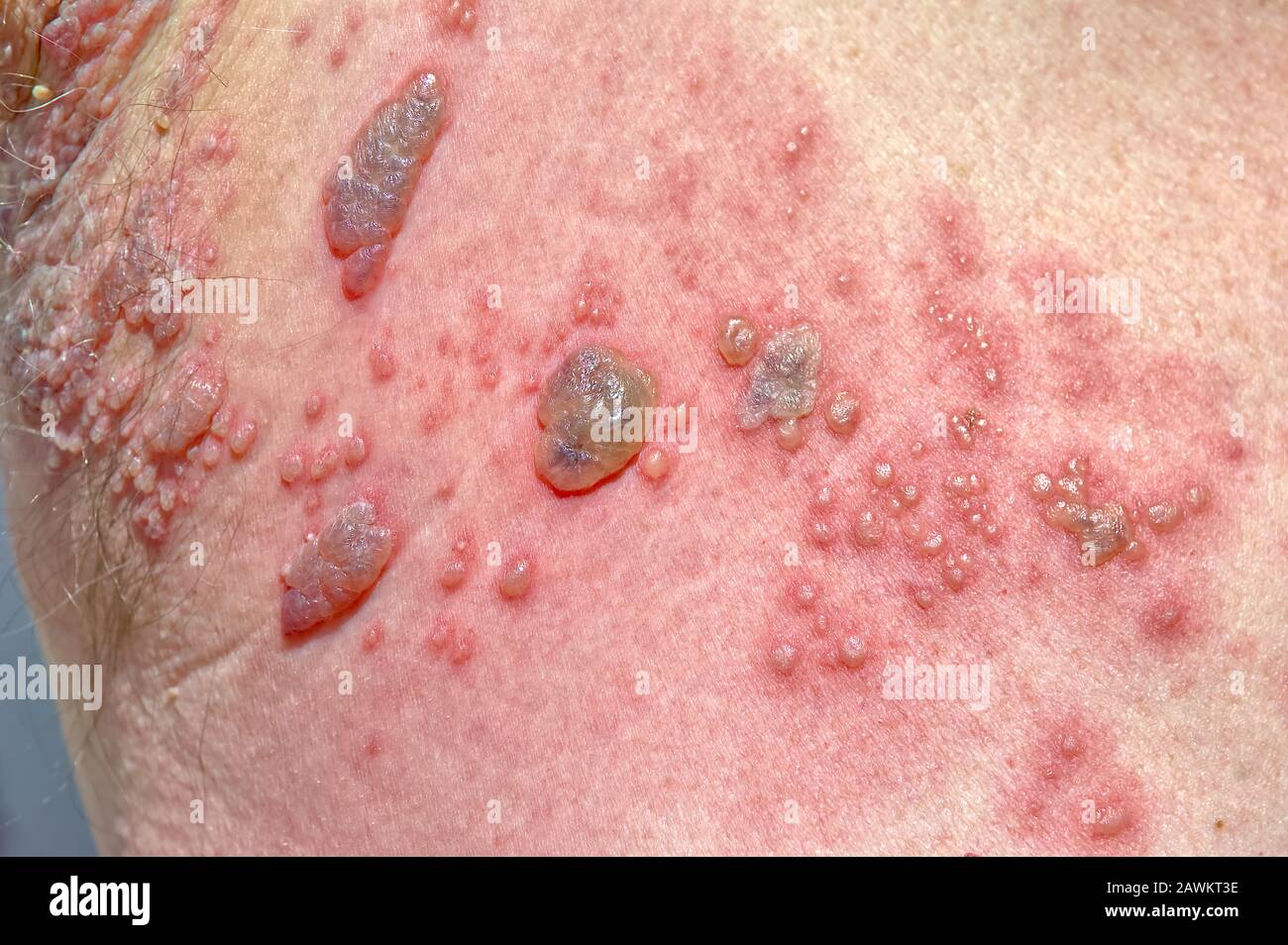 Shingles infection hires stock photography and images Alamy