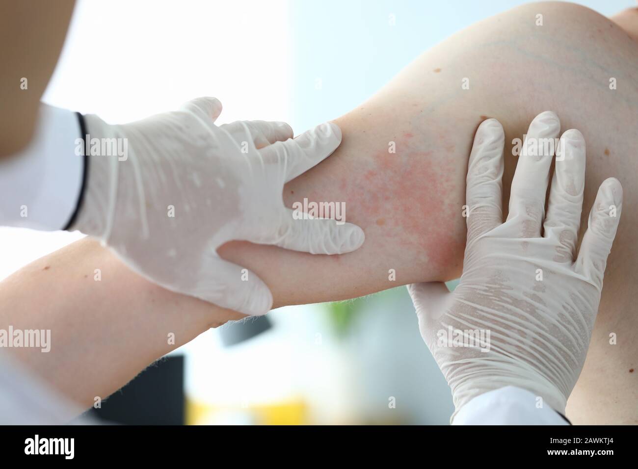 Closeup examination by doctor, allergic rash Stock Photo Alamy