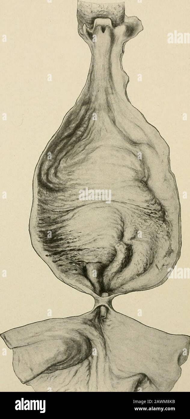 The practice of surgery . tion of theesophagus greater andgreater, the  patients nu-trition more and more dis-turbed, until, finally, deathfrom  starvation results.Von Mikulicz believed alsothat cardiospasm predis-poses  to cancer. The treatment is