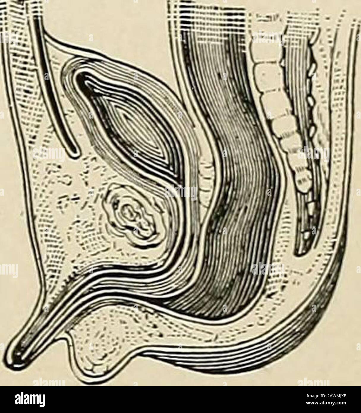 The Practice Of Surgery A B C Fig 34 Imperforate Anus T Ith Different Cloacal Openings Male A Terminat Ing In Bladder B Terminating In The Urethra C Terminating At The Meatus Esmarch Bowel From
