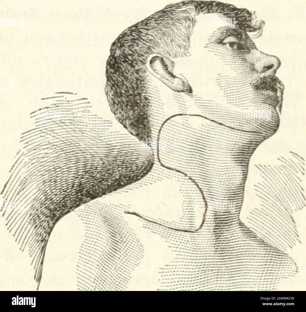 Sajous's analytical cyclopædia of practical medicine . nflamed it can bekept from ulcerating by insertingcrucial horsehair strands through theabscess from the sound skin; if per-foration of the skin does take placeit soon closes under a dry zinc per-oxide dressing. Chaput (Paris med.,Apr. 22, 1916). Rapid and complete healing is al-ways realized in the writers casesafter excision of tuberculous glandsin the neck, owing to his routine pro-cedure of suturing immediately with-out draining. In more than half ofhis 63 cases the gland burst and pusinundated the field, but his assump-tion that the pu Stock Photo