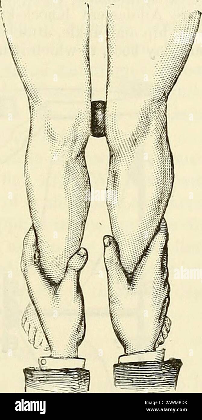 A system of surgery : theoretical and practical . keep the knee extended during active treatment by an unyielding padded splint ofany material along the back of the joint to prevent its bending, and to apply a simi-lar contrivance along the outside of the joint to maintain adduction of the leg. The side splint should be thickly padded along one-fourth of its length only atboth extremities, leaving the middle portion unpadded so as to present a hollow intowhich the joint may be drawn by a roller bandage or straps and buckles (see fig. 39).Should the case be more severe than in the above figure, Stock Photo
