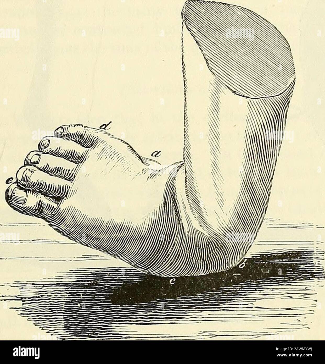 A system of surgery : theoretical and practical . t most with talipes varus, orordinary club-foot. The front of the foot is more or less turned out in each of thesevarieties, instead of being inverted as in varus. In valgus the peronei are the musclesmainly contracted ; in equino-valgus the tendo Achillis is also tense, and the heel ele-vated, the toes at the same time pointing outwardly. In congenital calcaneo-valgusthe heel is depressed through the contraction of the anterior tibial, and the toes pointedoutwardly from tension of the peronei. In non-congenital calcaneo-valgus thedepressed hee Stock Photo