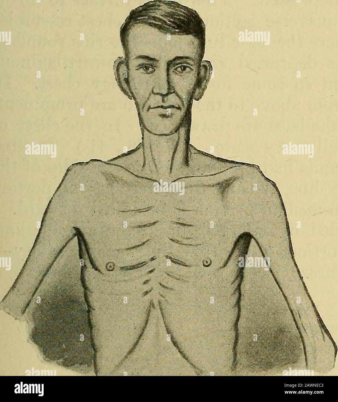 A practical treatise on medical diagnosis : for students and physicians . s are slanting, the epigastric angle is particu-larly sharp. The shoulders are not high, the scapulae are prominent—so marked in many cases that the term alar, or winged chest hasbeen applied to it. Associated with this type of chest the neck is loug, the larynx(Adams apple) very prominent, the arms are long. The patient isloosely put together; the length of the long bones is increased. It is known as the phthisical, phthisinoid, or tuberculous chest (seeFigs. 38 and 39). Although the term tuberculous is applied to thech Stock Photo