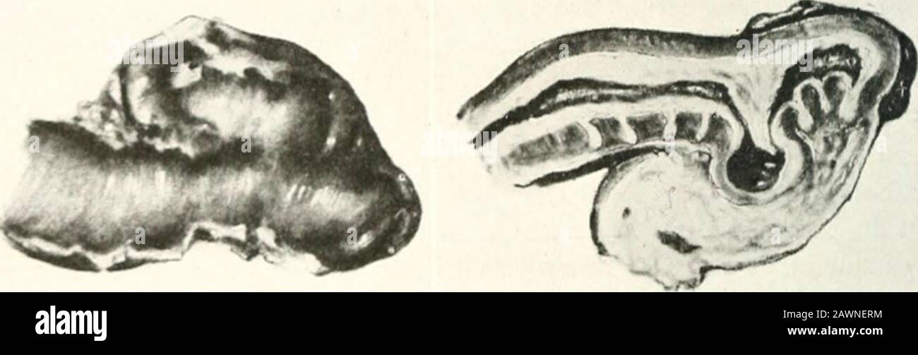 Studies from the laboratories of the Deptof Surgery . gtli. 1.,^ cm. in diameternear the base and 1 cm. in diameter at the tip. It was reddened and edematousthroughout, but more markedly so in the distal half, which was covered with agreenish-yellow fibrinous exudate. The mesenteriolum was also swollenand edematous, with a broad attachment. It was covered with a fibrinousexudate throughout its length. On longitudinal section, it could be seen thatthe thickening in the proximal half was due to a tremendous thickening of thesubmucosa. The nniscular coat was 2 mm. thick. Along the mesenteric bord Stock Photo