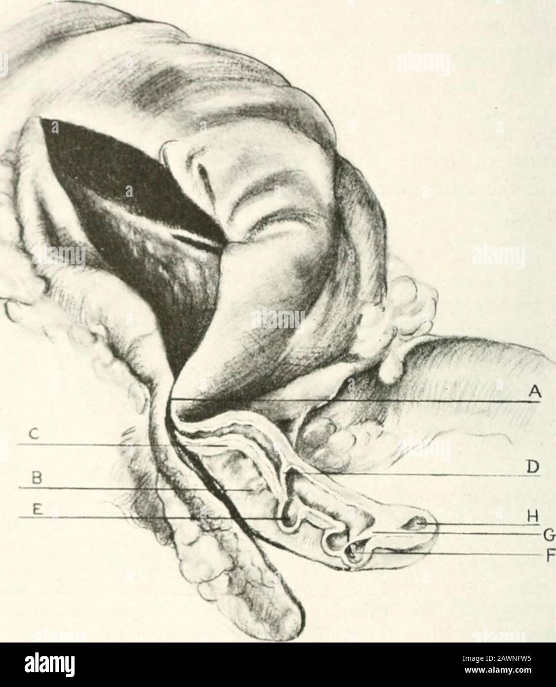 Studies from the laboratories of the Deptof Surgery . mesenteric border, through the moreproximal of which a protrusion of mucosa and submucosa had occurred for adistance of 4 mm. Through the more distal gap, not only had the mucosa andsubmucosa of the same side protruded, but also all the rest of the mucosa andsubmucosa of that region, so that the entire lumen had come to lie outsidethe appendix, within the sac of the diverticulum. From the diverticulum, thelumen passed back within the surrounding muscular coats once more in itscourse toward the tip, becoming markedly constricted as it did so Stock Photo