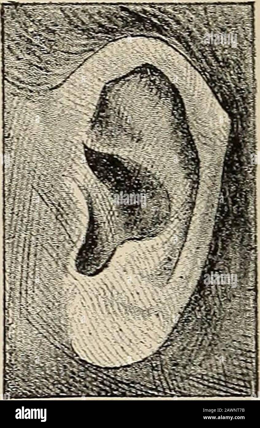 Nervous and mental diseases . Fig. 291.—Stahl ear, Xo. Fig. 292.—Darwin  ear. XVIII. The ear with too large or too small a concha. XIX. The ear with  continuous fossa scaphoidea. The fossapasses