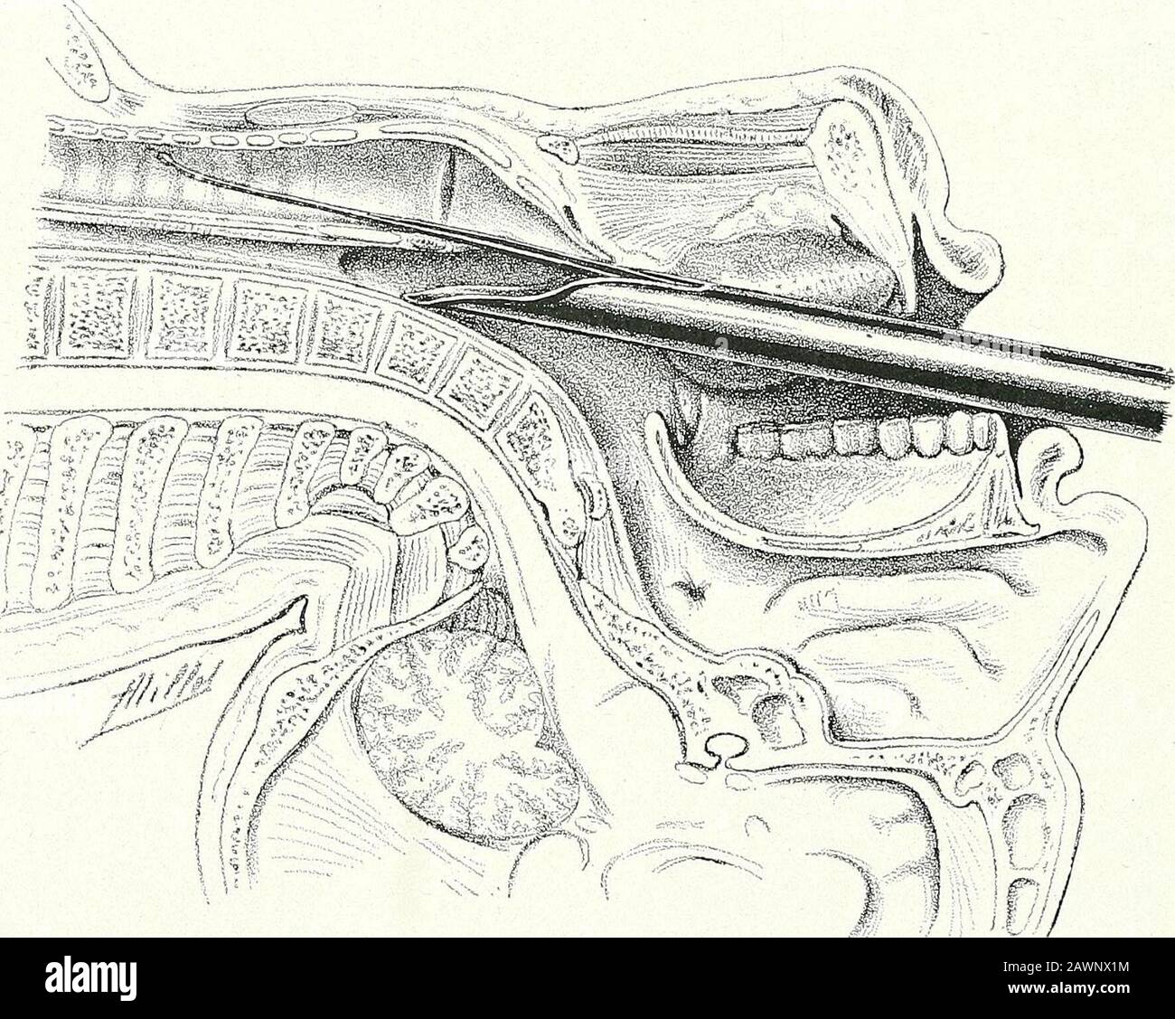 Surgical therapeutics and operative technique . Fig. 355.—Direct Laryngoscopy by the Authors Method: Introduction ofTHE Pharyngeal Tube furnished with Mandril.. Fig. 356.—Introduction of Intralaryngeal Conductor by the AnteriorCleft of the Pharyngeal Tube. OPERATIONS ON THE NECK 217 of the trachea and bronchi. Special forceps, the jaws of which are controlledtlirough a long stem, enable us to reach foreign bodies, which are easilyextracted by this technique. Stock Photo