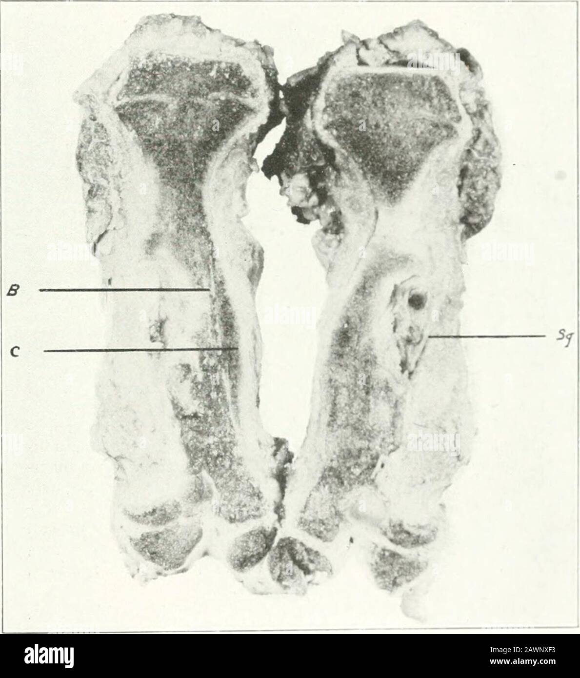 Studies from the laboratories of the Deptof Surgery . Fig. 18.—Osteomyelitis in a dog caused Ijy the injection of Stafhylo-coceut aureut in the medullary canal: .Sl;., cortical sequestrum. Markednew bone prorri»Atral bone prolifrration on the opposite side. Figures 18,19, 20 and 21 arc the same case.. Fig. 19.—Cross-section of bone: Sq., sequcslrum; B, rarefied cortex; C. sub-periosteal bone proliferation. 24 earliest relief oi this pressure sluiuUl he aecduiplisliedby exploratory operation and drainage. If pressureis not relieved, it is logical to assume that the throm-bosis of the entire nut Stock Photo