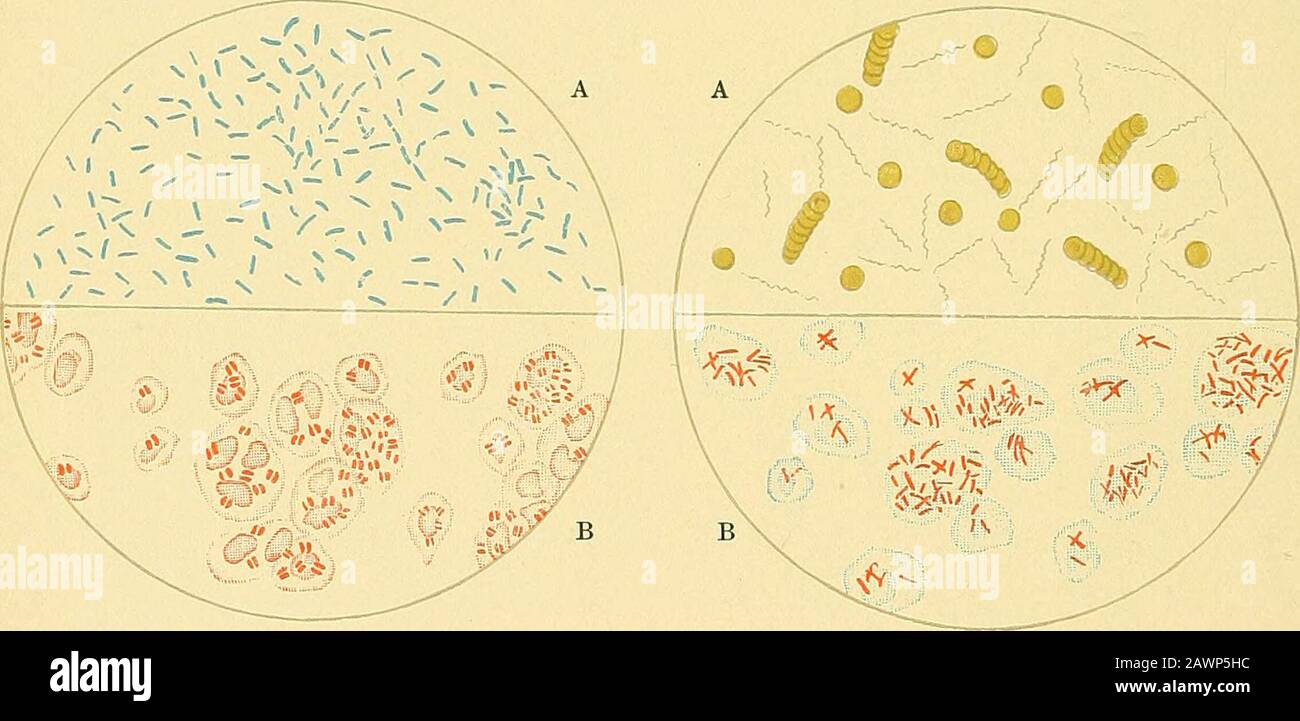 A practical treatise on medical diagnosis : for students and physicians . A. Comma Bacillus. B Gonococcus.Fig. 5. A. Recurrent Spirilla. B. Leprosy.Fig. 6. Stock Photo