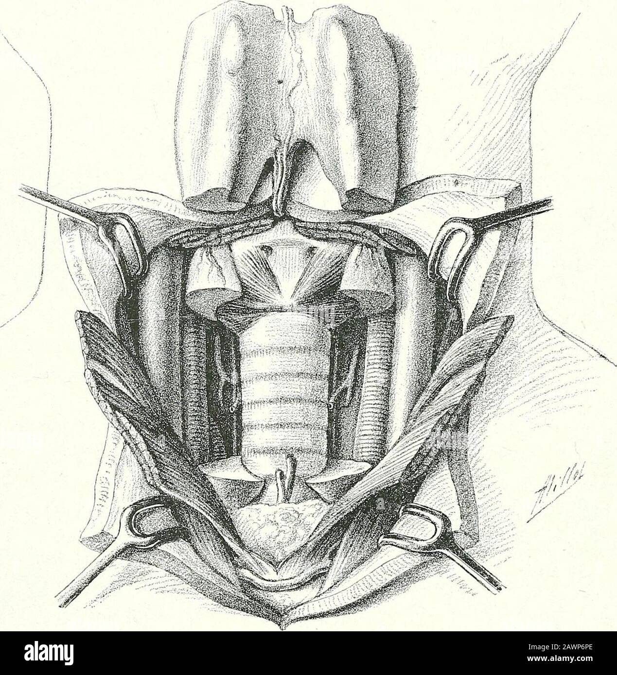 Surgical therapeutics and operative technique . Fig. 325. — Goitre de-veloped IN THE LowerPortion of the EightLateral Lobe. Fig. 326. — UnilateralGoitre developed atTHE Expense of theRight Lobe. Fig. 327. — PlungingOR Retro-SternalGoitre. 196 SURGICAL THERAPEUTICS (AND OPERATIVE TECHNIQUE goitre as far back as 1897. Figs. 325 and 326 respectively represent a goitredeveloped in the lower part of the right lateral lobe, and a unilateral goitreof the whole of the right lobe. In the former there is a single groove ofecrasement; in the latter are three, involving the superior and inferiorpedicles a Stock Photo