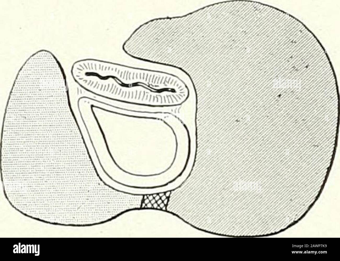 Surgical therapeutics and operative technique . Fig. 323.—Retro