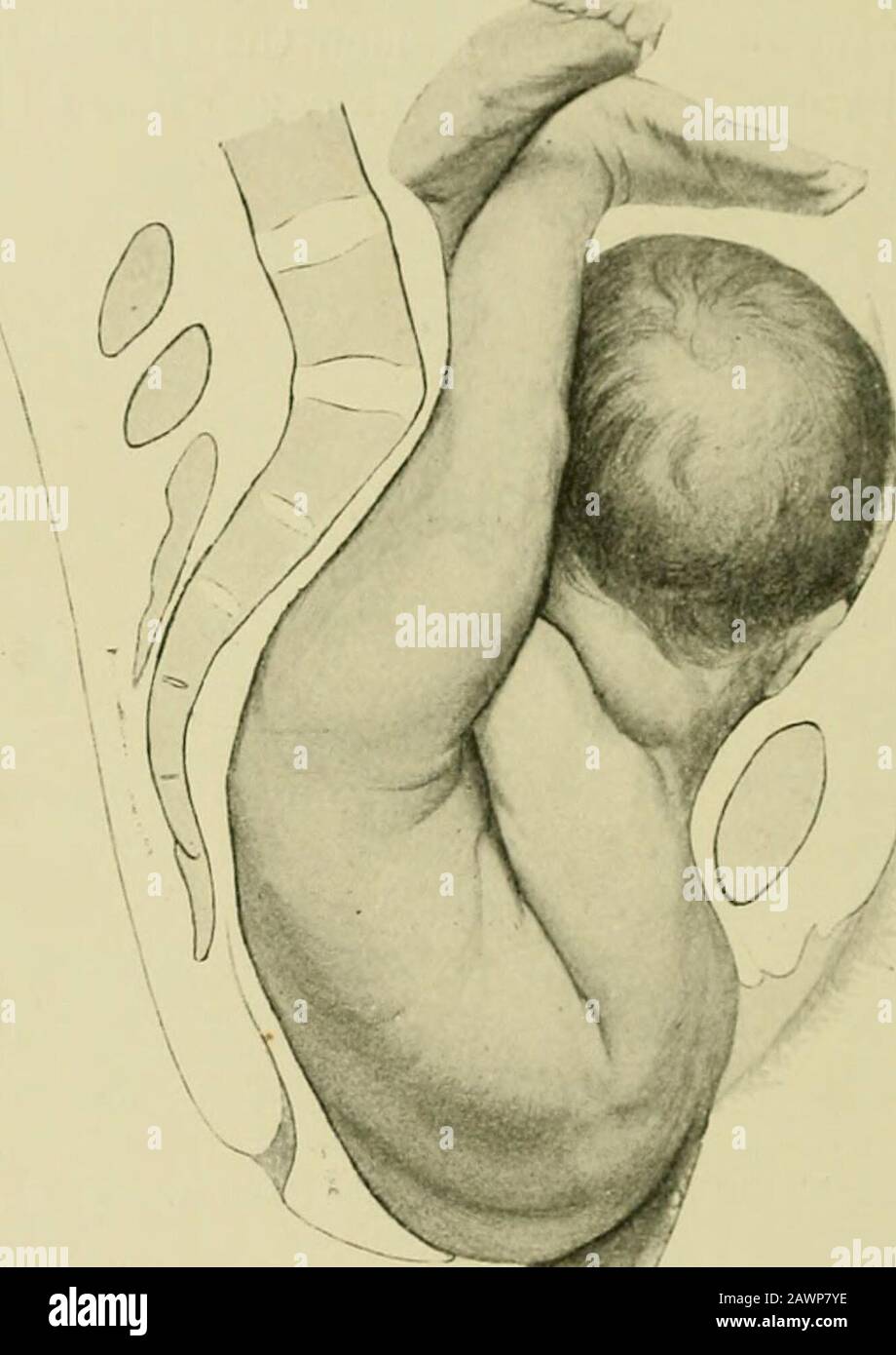 Operative Midwifery A Guide To The Difficulties And Complications Of Midwifery Practice Mentioned Prematurity Macera Tion And Deformity The Natural Course Of Labour In An Oblique Presentation Is For Theshoulder To