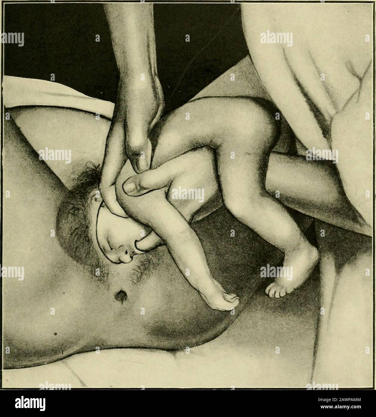 Operative midwifery : a guide to the difficulties and complications of midwifery practice . Fig. 42.—The First stage in the Delivery of the After-coming Head Manriceau-Smellie- Veil Method . Nagel.) The illustrations of two other methods—the Prague and theWigand-Martin (Figs. 44 and 45)—explain sufficiently the manner of BREECH PRESENTATIONS !?&gt; their employment. They are not much used, the former becausethere is great danger of injuring the spinal column, and the latterbecause one cannot exert so much traction. They are useful, however,,if the operator is single-handed. Another difficulty Stock Photo