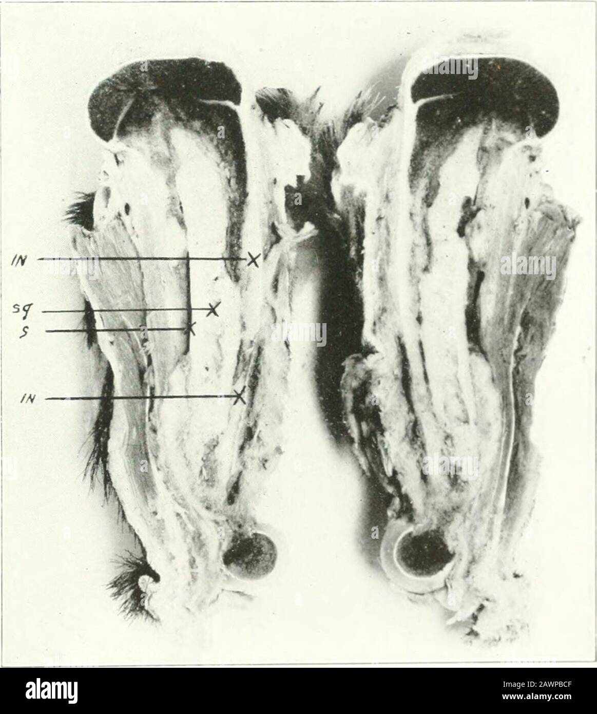 Studies from the laboratories of the Deptof Surgery . 1919: SQ,sequestrum; In, involucrum; S, separation zone. working in the labfjratory of surgical research at Columbia University,found bone almost universally in fascia lata transplants tliat he hadmade to fill a defect in the bladder. yy theory, therefore, tliat wemay accept should &gt;c broad enough to explain these irregular types ofbone formation as well as the repair of bone following fractures andinfection. We may. for the sake of discussion, classify the theorie.;of bone repair roughly into three groups: () periosteal; (2) osteo-bla Stock Photo