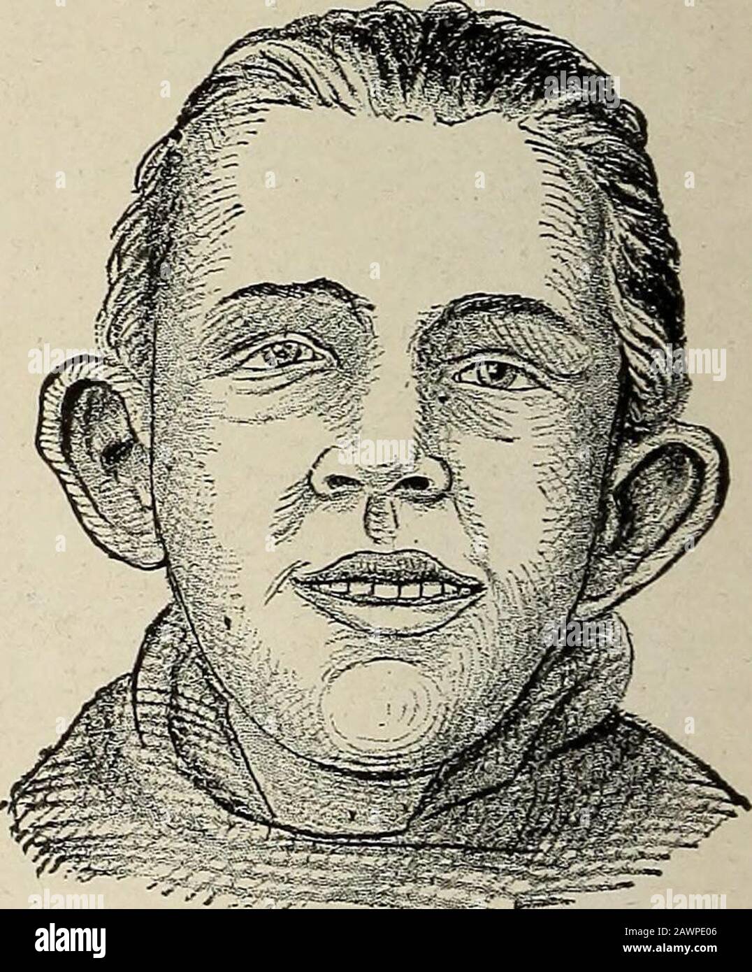 Nervous and mental diseases . Fig. 289.—Blainville ear; also excessive lengthof ears. Fig. 290.—Morel ears. X. The Stahl ear, No. I.1 A series of anomalies of the helix.The helix is broad, like a band, and coalesces with the cartilages See Zeitschrift fur Psych., vol. xvi. GENERAL ETIOLOGY OF INSANITY. 719 of the crura furcata. The fossa ovalis and fossa scaphoidea arescarcely to be seen. The lower half of the helix is obliterated. Thereare occasionally slight variations from this type. XI. The Darwin ear; helix interrupted where its transverseportion passes into the descending, and at this po Stock Photo